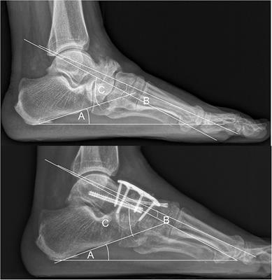 Individual Surgical Treatment of Stage IV Müller-Weiss Disease According to CT/MRI Examination: A Retrospective Study of 12 Cases